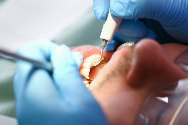 Best Emergency Treatment for Dental Infections or Abscesses in Lebanon, IL