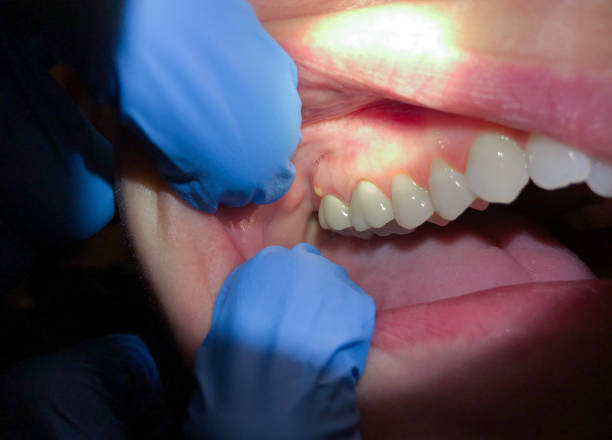 Best Emergency Dental Care for Broken or Chipped Teeth in Lebanon, IL