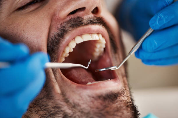 Best Emergency Gum Treatment in Lebanon, IL